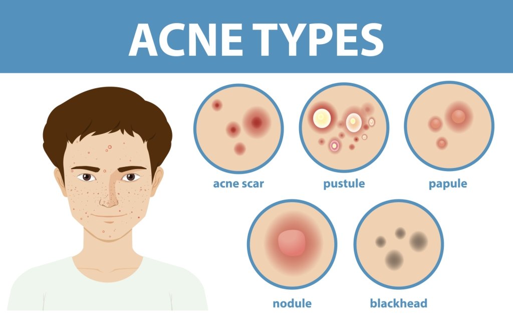 Acne Types Health Hyme