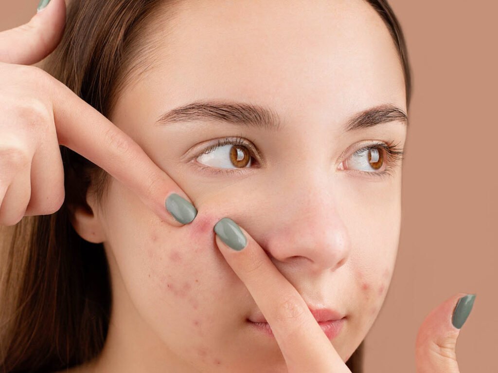 acne_scars_healthhyme