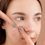 acne_scars_healthhyme