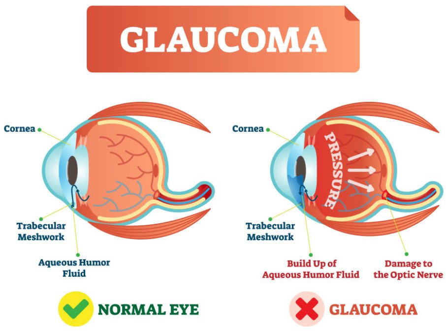 Glaucoma Eyes Healthhyme