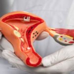Ovarian Cancer Healthhyme