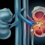 Kidney Stones