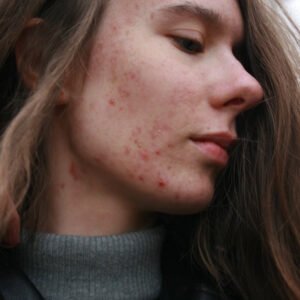 Acne Scars