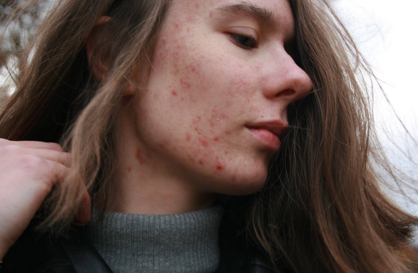 Acne Scars