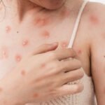 MonkeyPox Virus