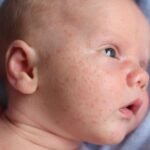 Baby eczema